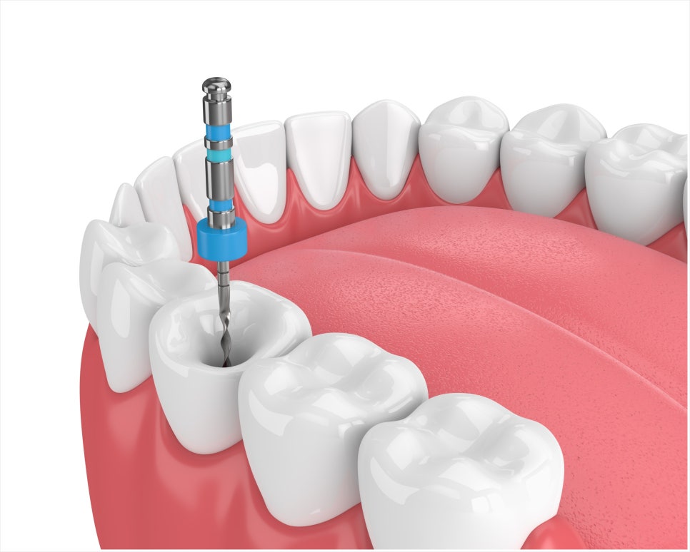 Why Is a Crown Placed After Root Canal Treatment? image 2