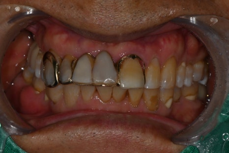 Understanding Implant Price Differences Through the Molar Implant Process image 5