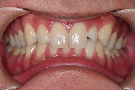 Do Men Get Laminates Too? The Choice of a Man in His 20s Who Became Naturally More Attractive image 4