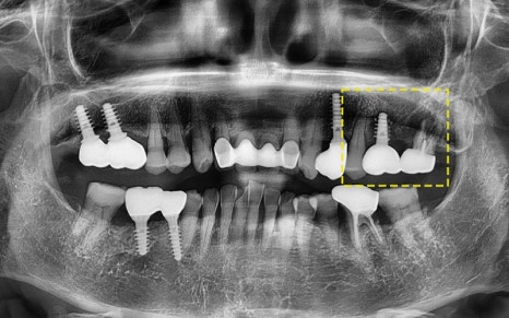 Samjeon Station Implant: Why do some break while others can last a lifetime? image 3