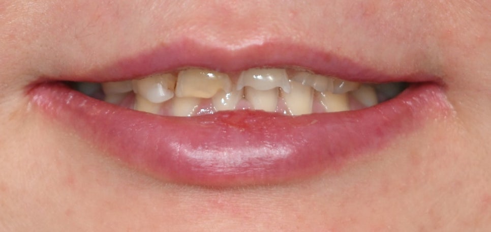 Treatment with Objetto Laminate Veneers After a Chipped Front Tooth image 12