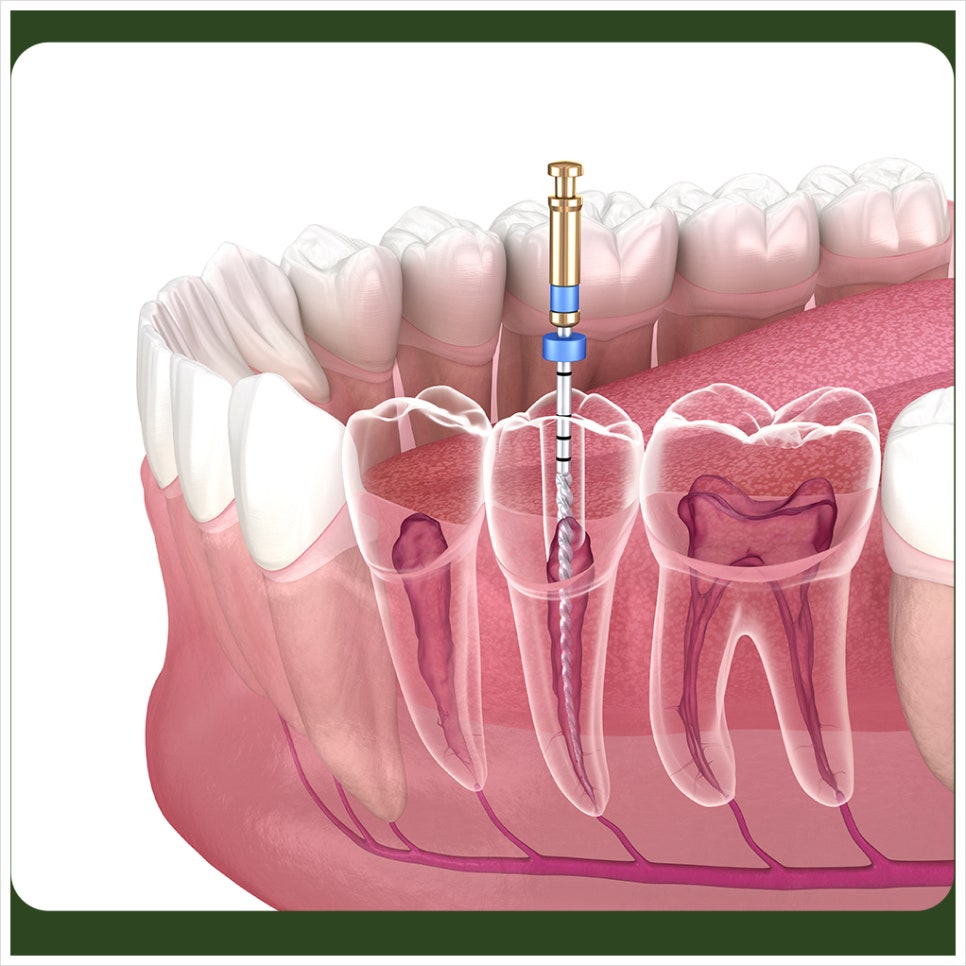 Stopping Root Canal Treatment Is Not Okay — You Must Finish It to the End! image 4