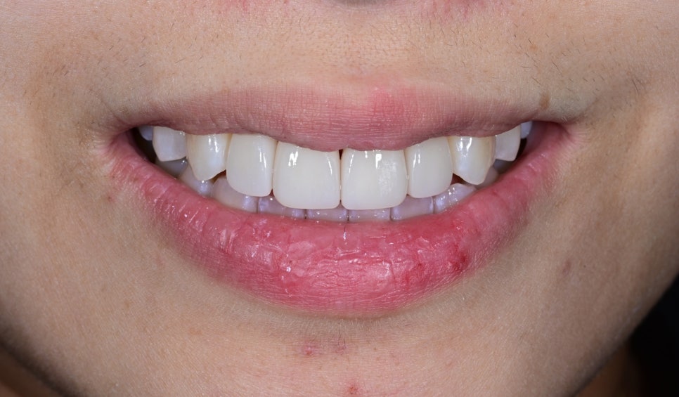 Laminate Veneers for Protruding Teeth: If They’re Too Thick, They Look Even More Prominent image 9