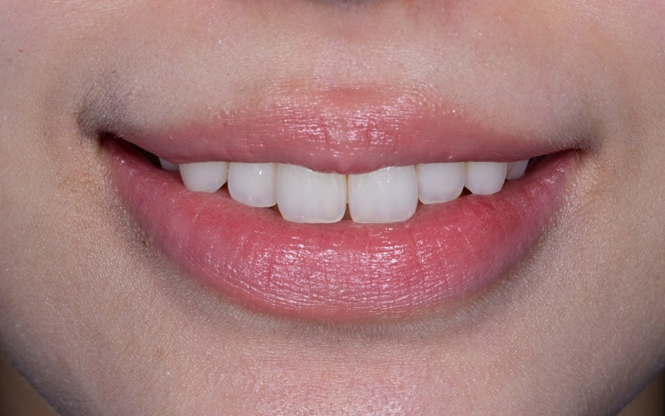 Canine Veneers Without Orthodontic Treatment image 6