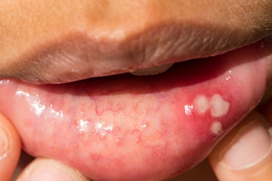 Mouth Sores (Stomatitis) — Causes & A Complete Guide to Healing Fast image 2