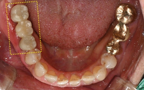 [Seokchon Gobun Station Dental Clinic] When Is an Implant Needed? image 8