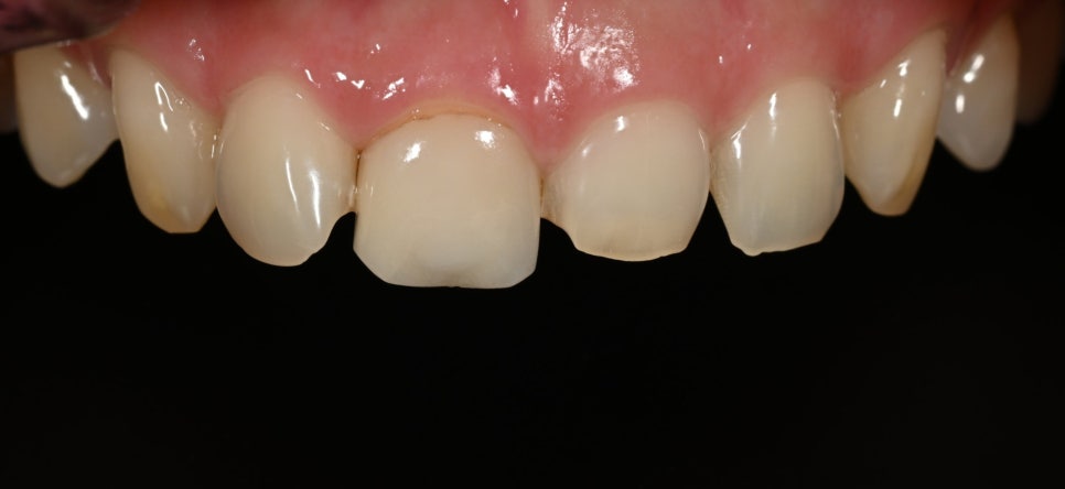 Tooth Wear: Resin? Veneers Are Also an Option image 1