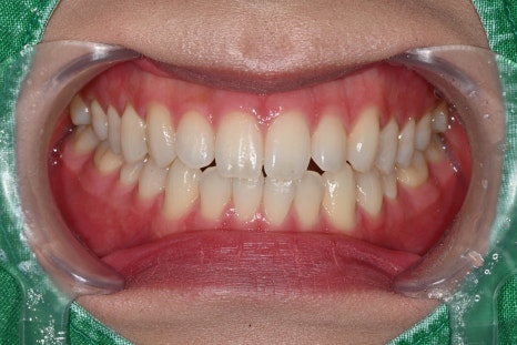 The Real Reason for the Price Difference in Laminates: See for Yourself with OVZERO Minimally Prepared Veneers image 5