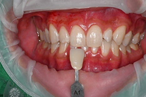 Do Men Get Laminates Too? The Choice of a Man in His 20s Who Became Naturally More Attractive image 3