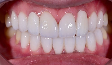 A Case of Simultaneous Laminate and Implant Prosthetic Treatment image 6