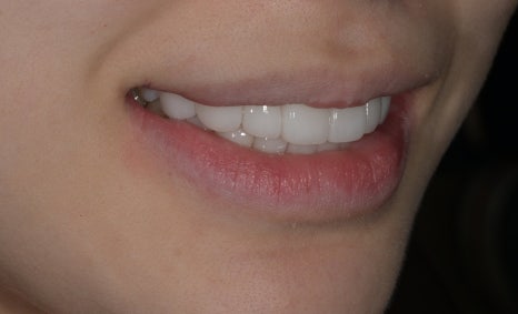 Canine Veneers Without Orthodontic Treatment image 13