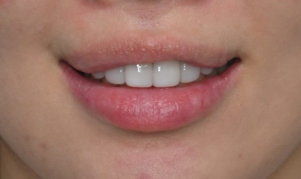 Jamsil Veneers: Worried About Rabbit Teeth? image 13