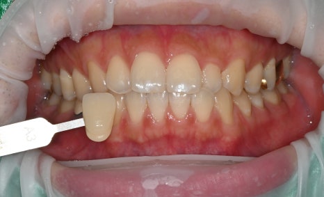 Wedding D-14, It’s Time for Whitening Now!🦷 image 3