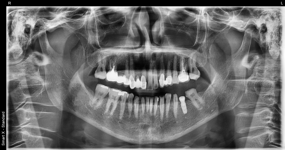Front Tooth Crown + Implant for an Overseas Patient: What Made It Possible to Finish in 4 Months? image 4