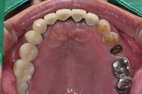 Broken Implant Crown, Reproduced at Seoul Of Dental Clinic Even for Implants from Another Clinic🦷 image 2