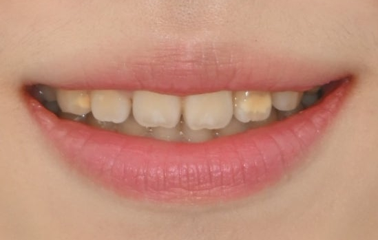 Samjeon Station Dental Clinic: A Case of Improving Discolored Teeth with No-Prep Ove Zero Laminates image 8