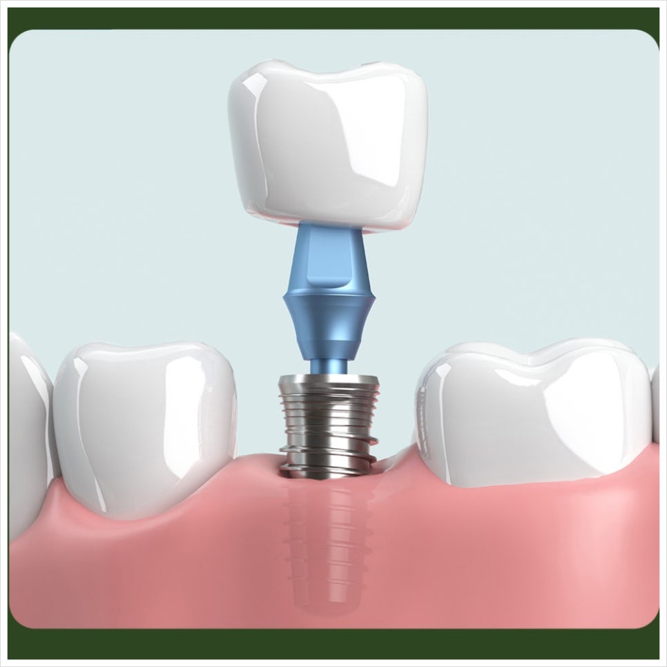 When Is Same-Day Implant Treatment Possible? image 3