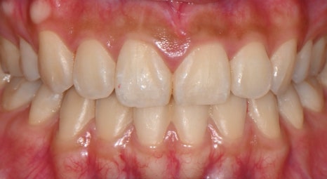 Samjeon Station Dental Clinic: "Without Orthodontics, Object Zero for the Smile Line of a Woman in Her 20s" image 3