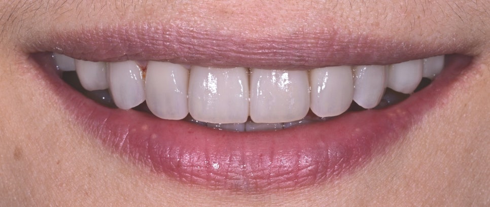 Objet Laminate Treatment for Seniors: Naturally Beautiful, Without Tooth Reduction image 15