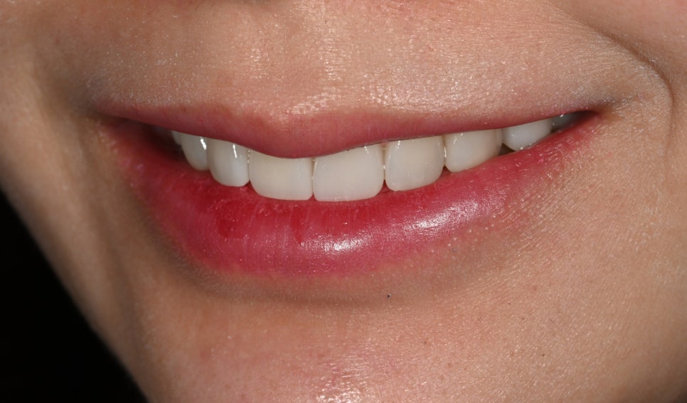 Tooth Wear: Resin? Veneers Are Also an Option image 10