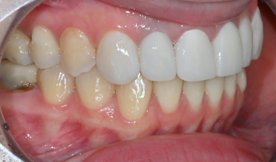 Discolored Front Teeth: Are Crowns the Only Answer? image 8
