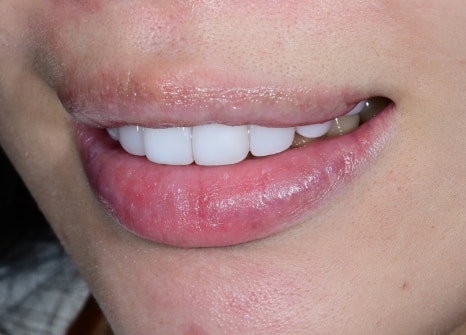 Jamsil Veneers: Worried About Rabbit Teeth? image 12