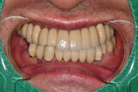 Immediate Implant Placement After Extraction! Seoulove Dental’s Fast Full-Mouth Implant Treatment Completed in 4 Months image 2