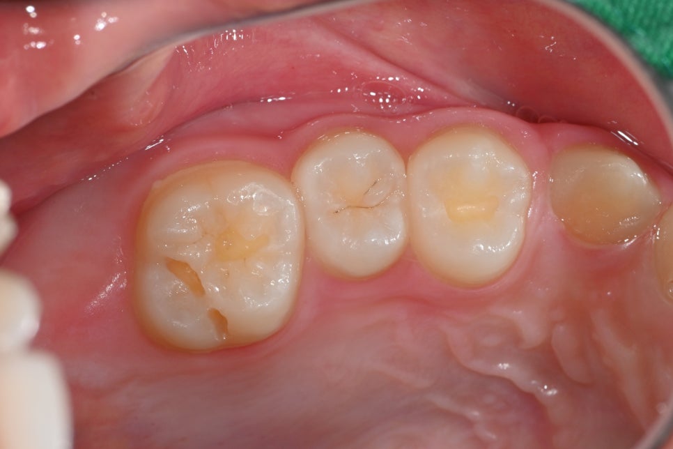 How to Restore Molars with Insurance-Covered Resin for Elementary School Cavities - Seoul of Dental Hospital image 2