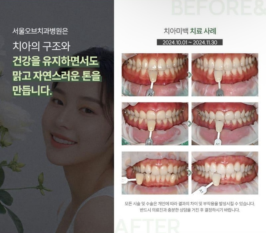 Jamsil Teeth Whitening Price: Why Is There Such a Big Difference? image 3