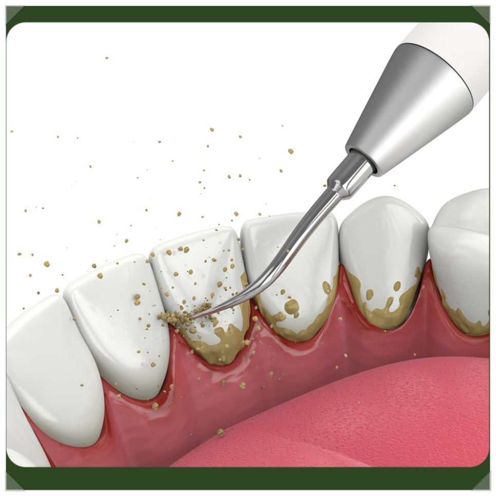 Bleeding After Scaling—Is Something Wrong with the Treatment? If You're Worried image 2