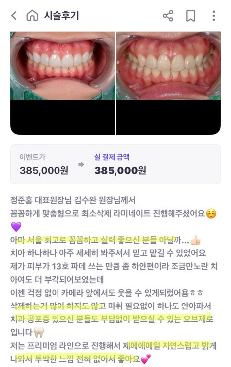 Jamsil Laminate: Cases Where Treating Just a Few Front Teeth Is Enough image 4