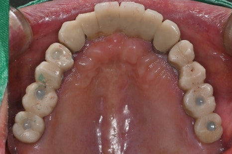 Immediate Implant Placement After Extraction! Seoulove Dental’s Fast Full-Mouth Implant Treatment Completed in 4 Months image 7