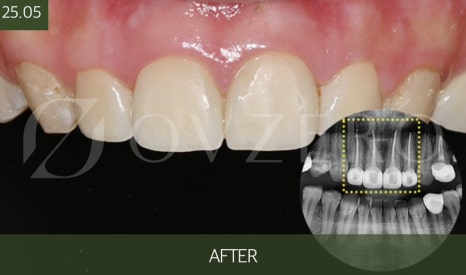 Jamsil Dental Clinic Zirconia Crown Price image 5