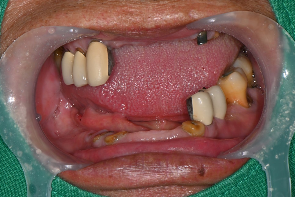 If Your Denture Keeps Coming Loose, What Should You Do? A Real Case Solved with Insurance-Covered Implant Dentures image 8