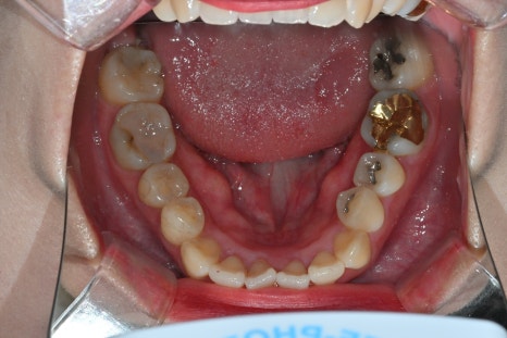 How We Naturally Improved an Upper Front Tooth Crown Retreatment, Including Color Differences and the Gum Line image 7