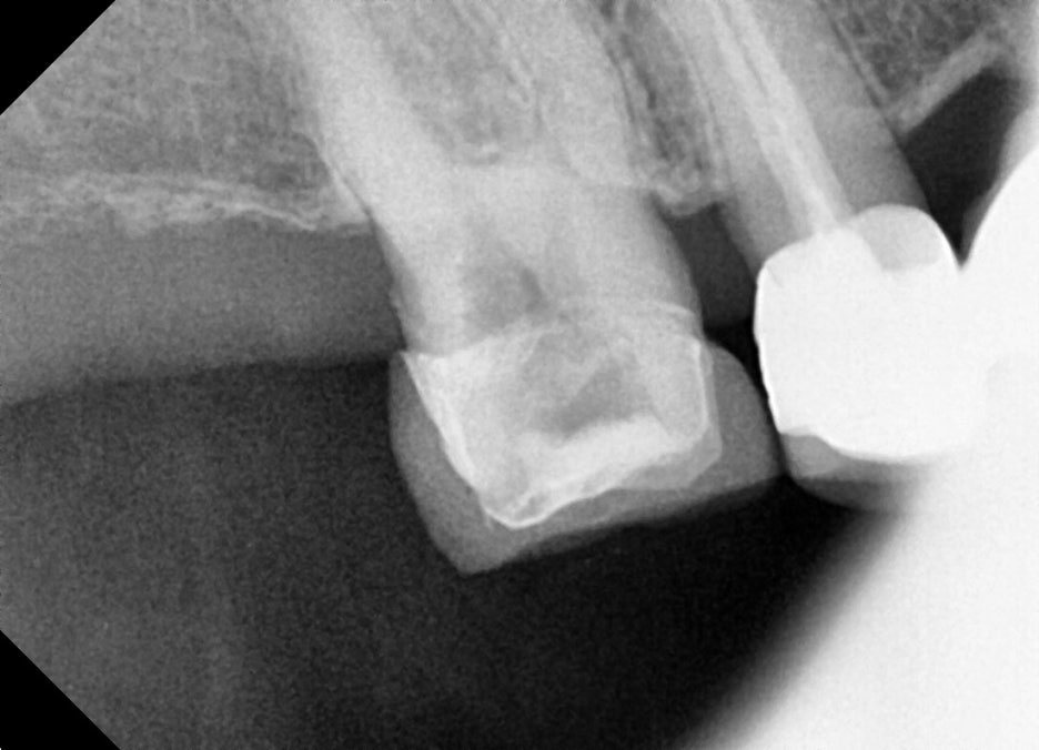 Why the First Root Canal Procedure Must Be Handled by a Specialist image 7