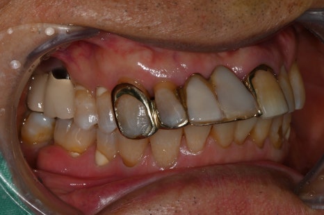 Understanding Implant Price Differences Through the Molar Implant Process image 4