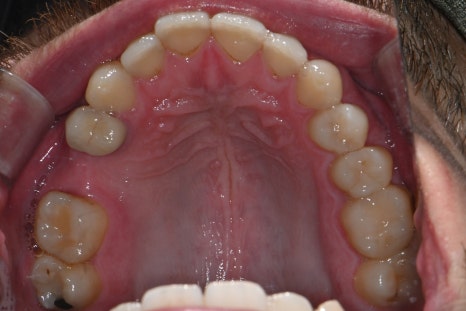 Implant Treatment Available for Foreign Residents Abroad! A Case Completed Perfectly Within 3 Months image 2