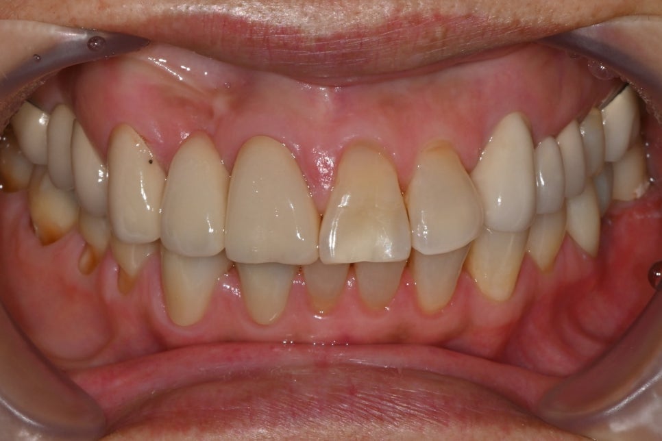 Front Tooth Crown + Implant for an Overseas Patient: What Made It Possible to Finish in 4 Months? image 6