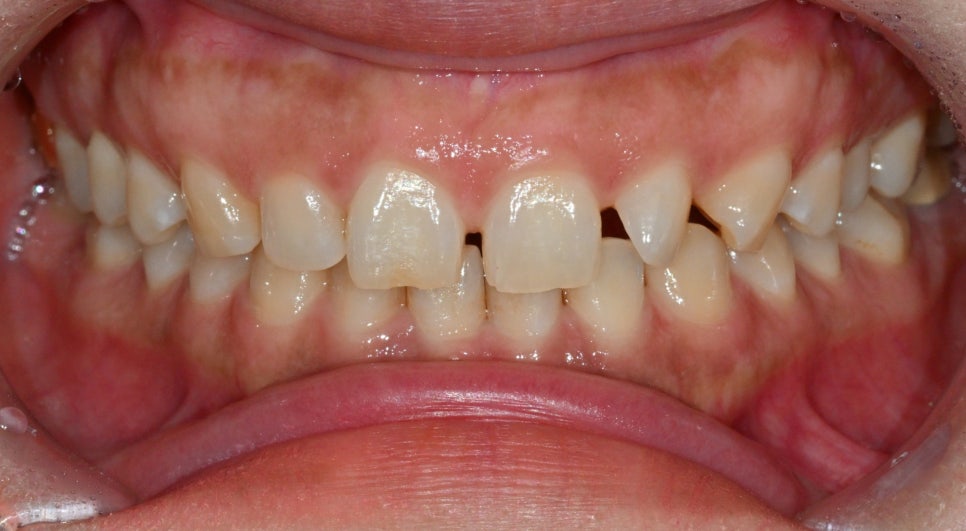 Can Gaps Between the Front Teeth Be Treated with Composite Resin? A Case Treated with Veneers image 1