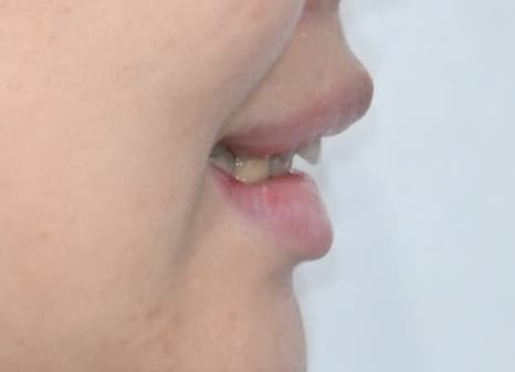 Jamsil Veneers: Worried About Rabbit Teeth? image 7