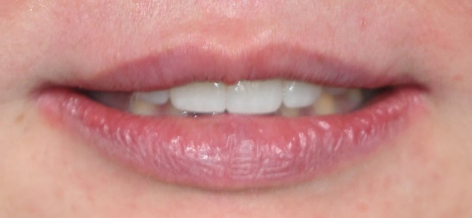 Treatment with Objetto Laminate Veneers After a Chipped Front Tooth image 13