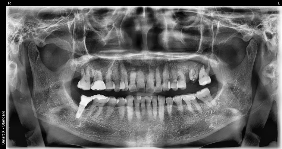 Songpa Dental Clinic: Is Insurance-Covered Implant Treatment Possible? image 4
