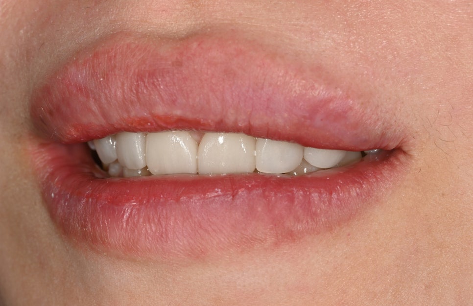 Can Gaps Between the Front Teeth Be Treated with Composite Resin? A Case Treated with Veneers image 9