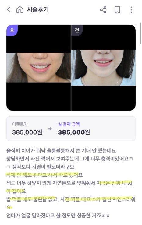 Jamsil Laminate: Cases Where Treating Just a Few Front Teeth Is Enough image 5