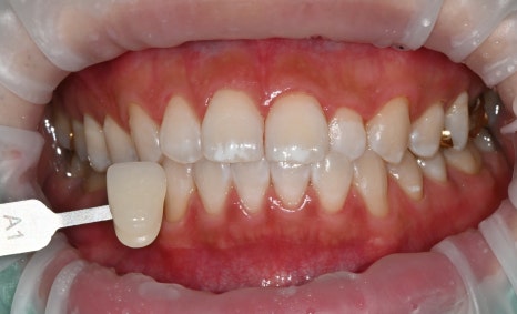 Wedding D-14, It’s Time for Whitening Now!🦷 image 4