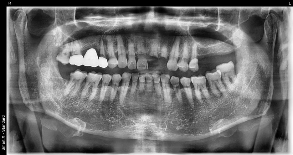 Songpa Dental Clinic: Man in His 70s Fell on Sidewalk Blocks, Requiring Laceration Suturing and Implant Surgery image 2