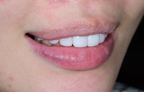 Jamsil Veneers: Worried About Rabbit Teeth? image 11