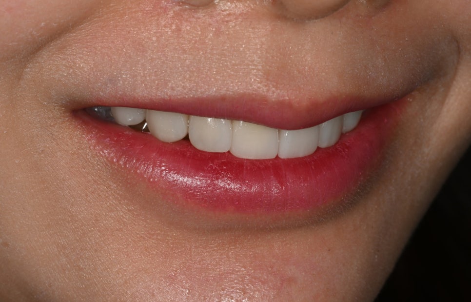 Tooth Wear: Resin? Veneers Are Also an Option image 9