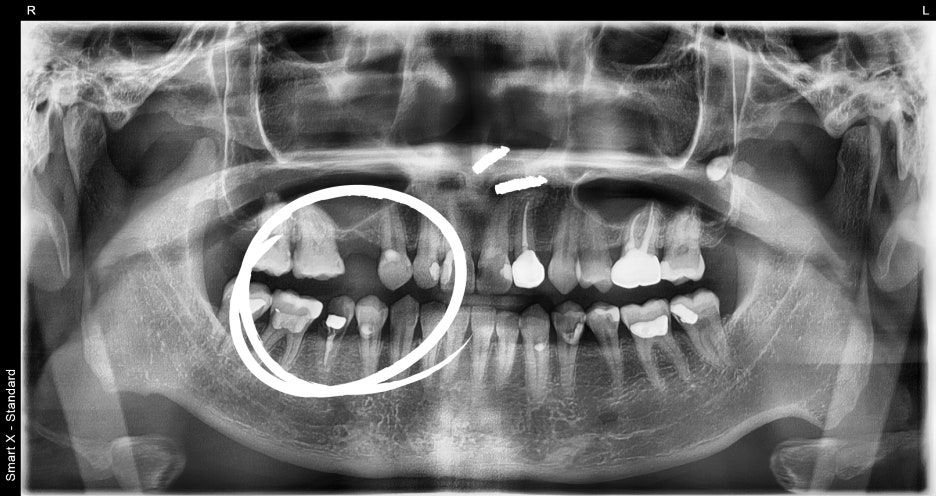 Songpa Dental Clinic: Implant After Molar Extraction image 4